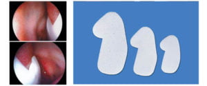 Nasal Splint