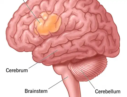25 Brain Tumor Treatments